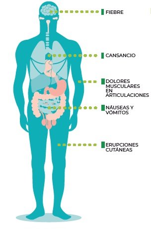 Infografía síntomas del virus Chikungunya