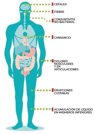 Infografía síntomas del virus Zika en personas